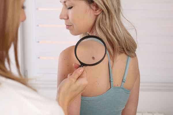 What Are Traditional Skin Lesion Removal Methods Greenford?