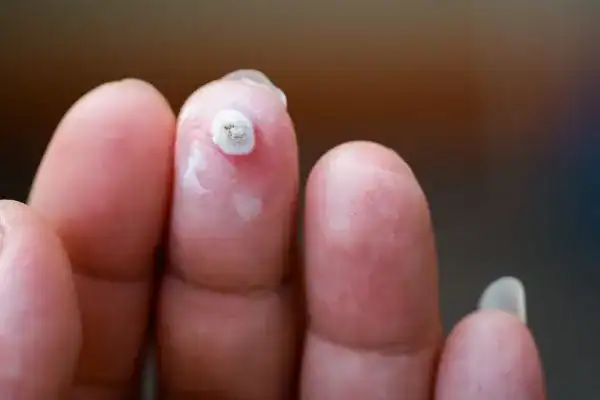Image of white wart before cryopen treatment Greenford