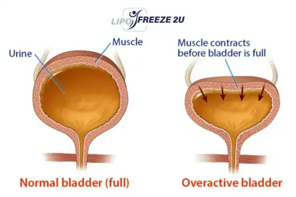 diagram of overactive bladder treatment Greenford