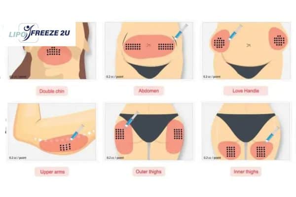 Benefits of Choosing Aqualyx for Fat Reduction Greenford