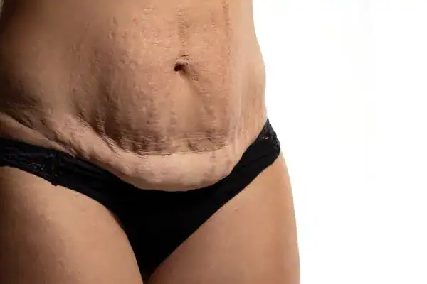 loose skin after weight loss injections Greenford