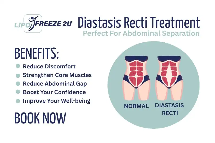 Benefits of body toning treatment Greenford for Diastasis recti