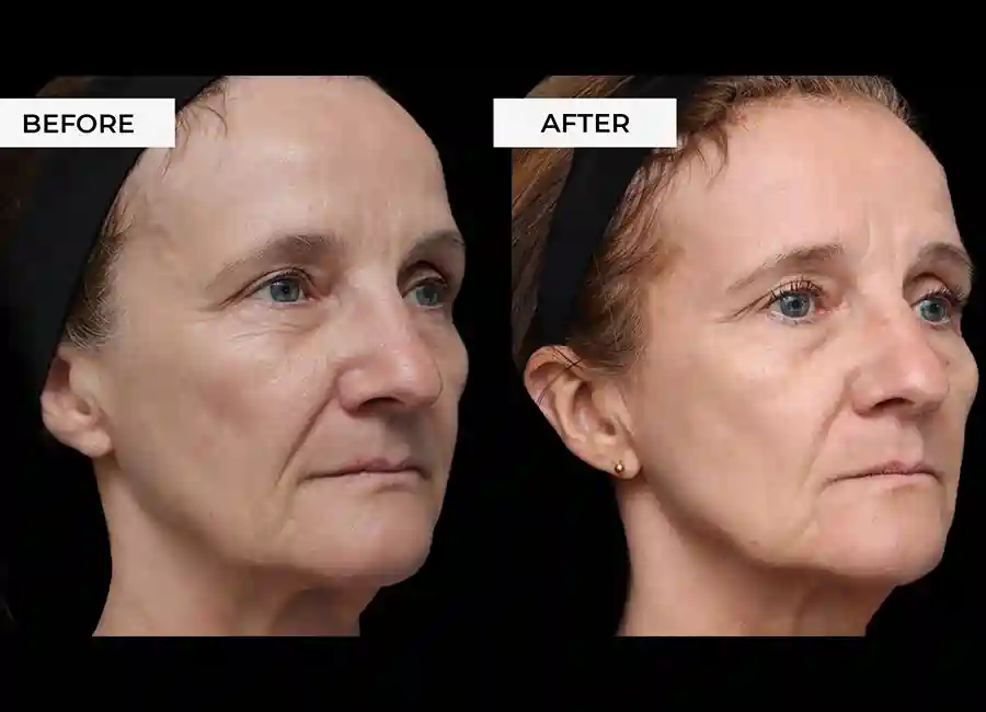 How Many RF Microneedling Sessions Will You Need to See a Difference Greenford?