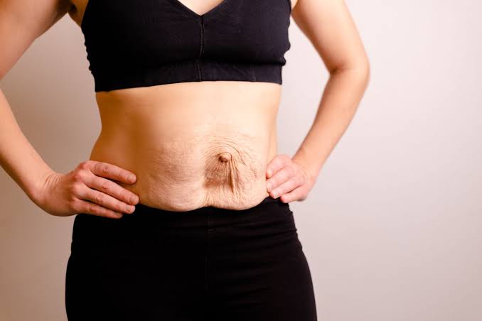 Is Surgery Really the Only Way to Repair Diastasis Recti Greenford?