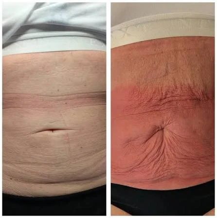How Does RF Microneedling Improve Crepey, Thin and Uneven Skin Texture Greenford?
