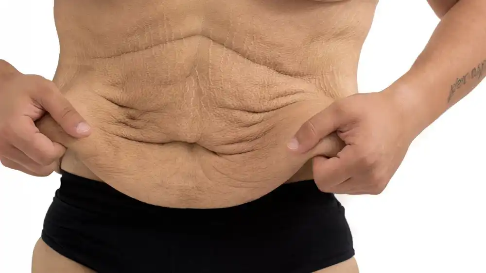 RF Microneedling for Loose Skin: How Can It Help Tighten and Reshape the Skin Greenford?